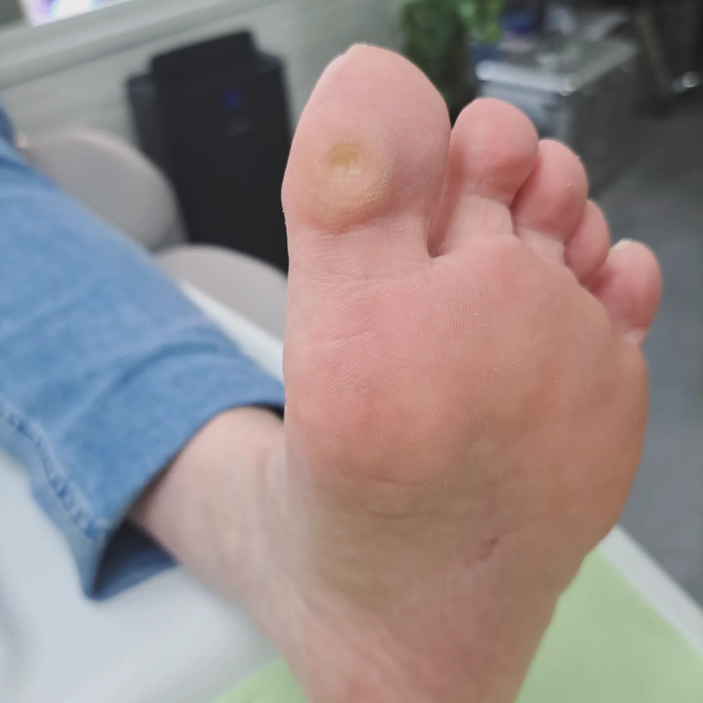Voetzool met een likdoorn onder de grote teen
